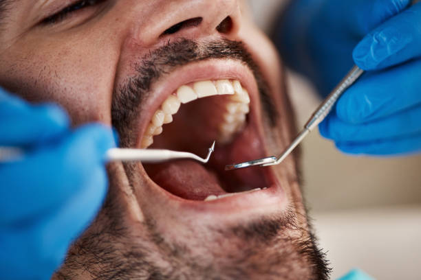 Best Emergency Treatment for Dental Infections or Abscesses in Muenster, TX